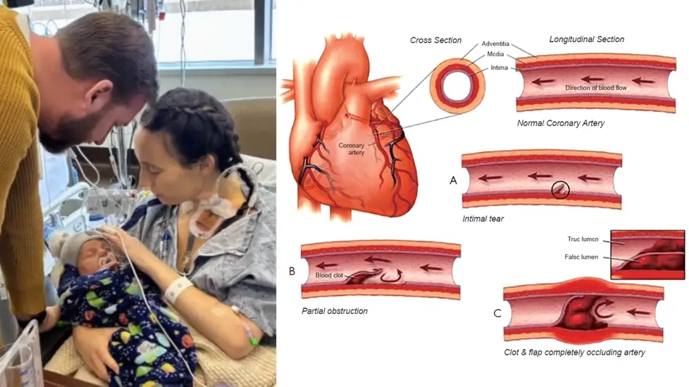 Postpartum Nurse’s Double Heart Attack Sheds Light on Hidden SCAD Risk