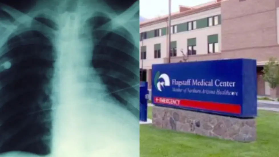 Two U.S. Plague Cases: Fatal in Arizona, Patient Recovering in California