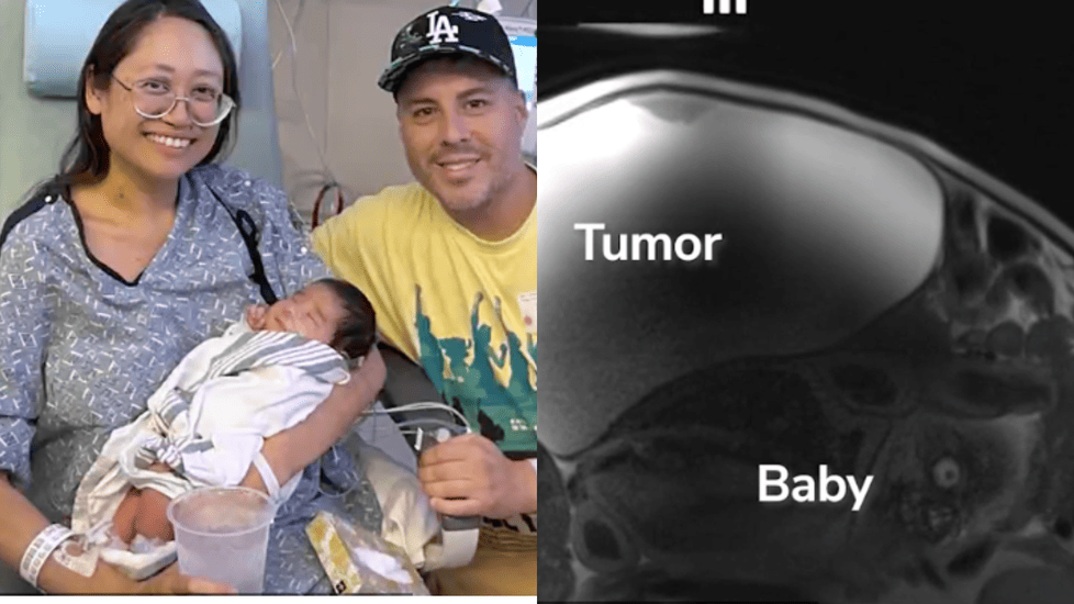 Nurse Didn’t Know She Was Pregnant Until Surgeons Found a Baby Behind Tumor
