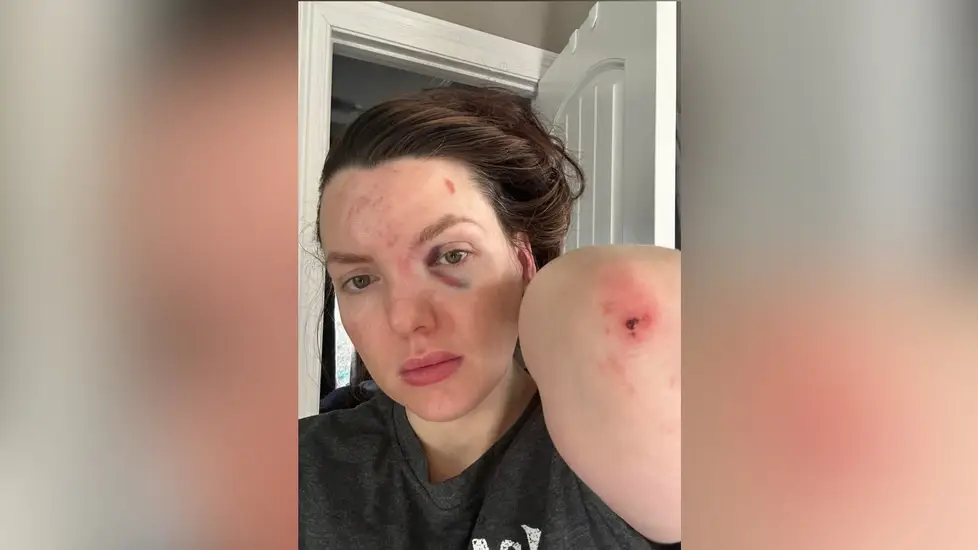 Nurse Attacked in Parking Lot Near UMMC—Speaks Out On Social Media