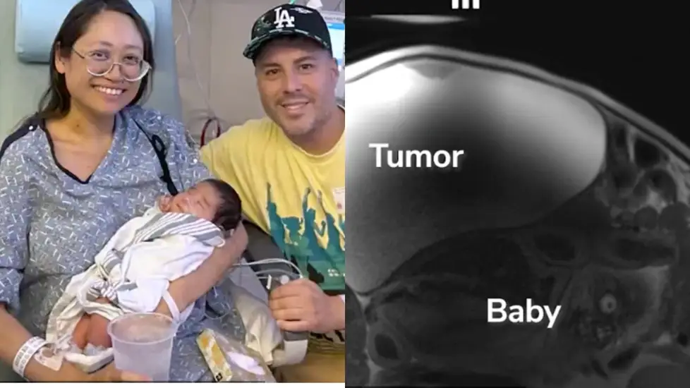 Nurse Didn’t Know She Was Pregnant Until Surgeons Found a Baby Behind Tumor