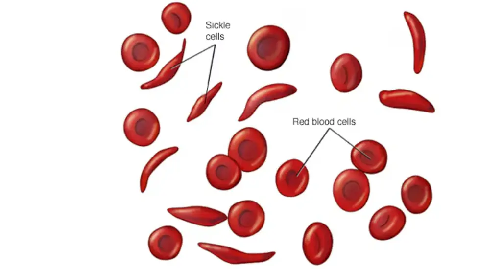 FDA Approves Gene Therapy for Sickle Cell Disease
