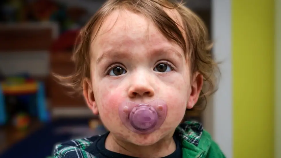 Measles Outbreak 2025 Update: What Nurses Need to Know Now